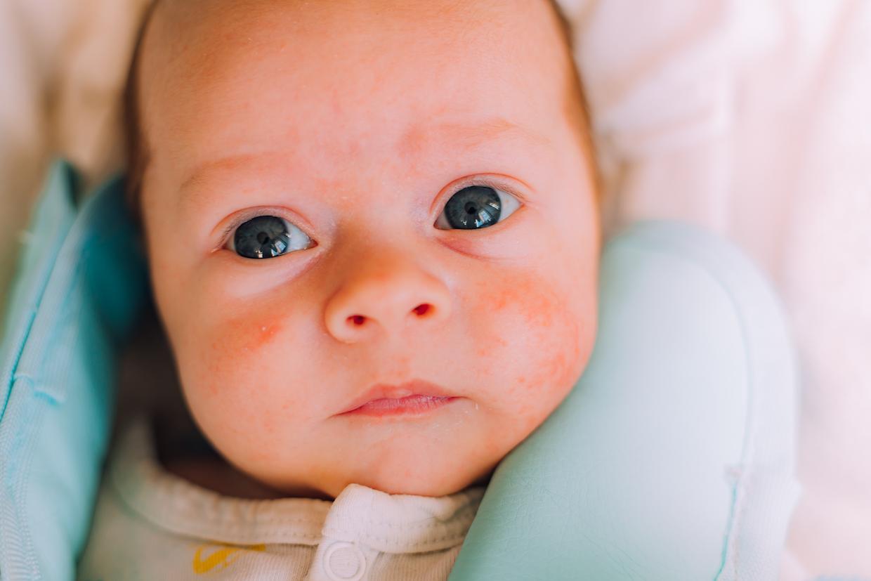 Comment éviter les érysipèles avec une sucette pour bébé ?